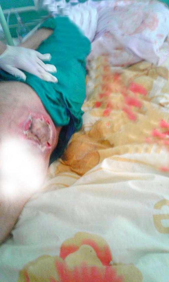 صورة مؤثرة: الإهمال الطبي ينال من امرأة بمستشفى الحسني ويتسبب في تَوَرّم لَحْمها