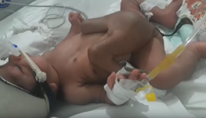 بالفيديو.. ولادة طفل بأربعة أرجل وعضوين ذكريين